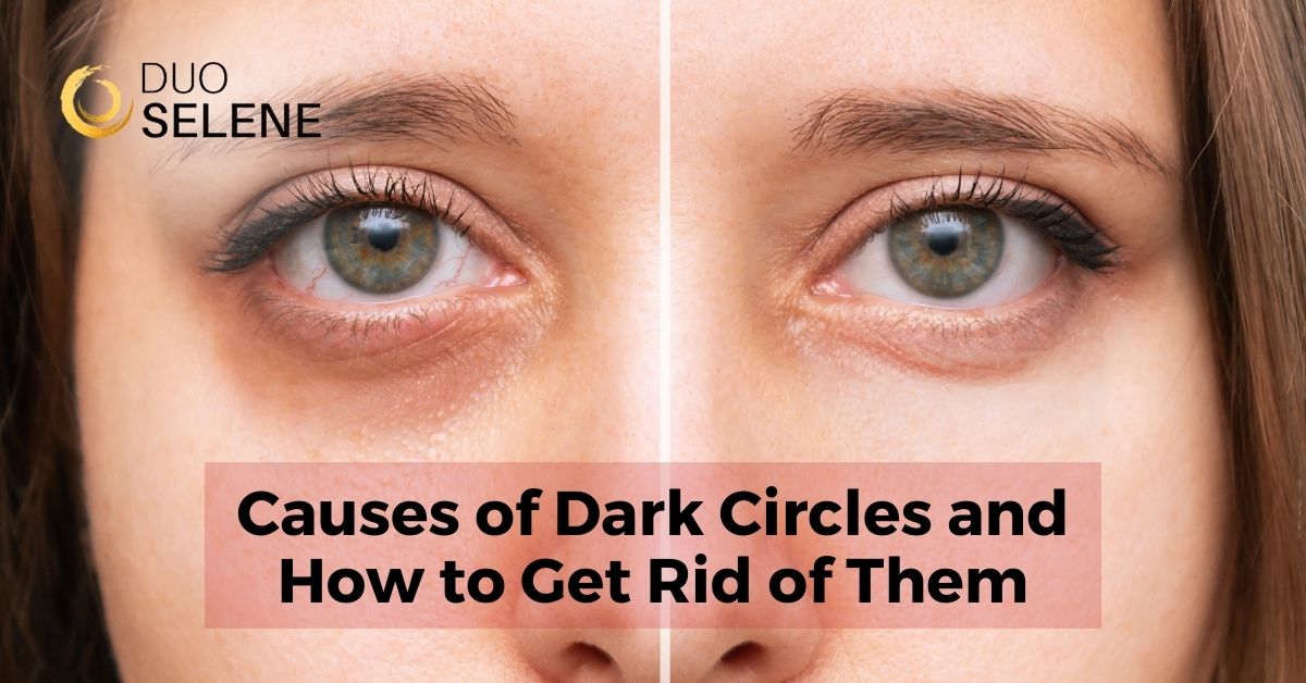 Say Goodbye to Dark Circles Under Eyes: Tips and Tricks