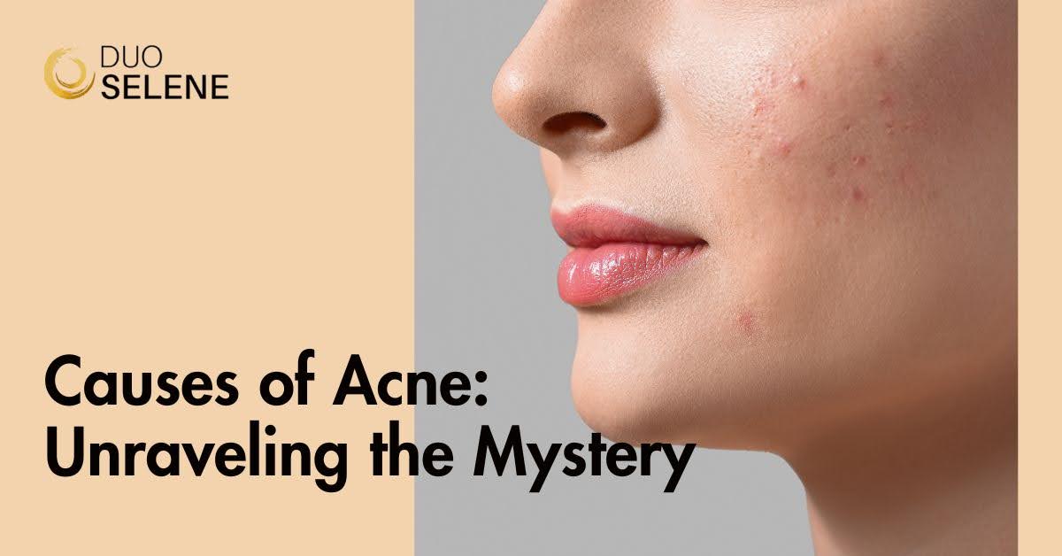 Understanding the Causes of Acne: Unveiling Solutions and the Power of Duo Selene Eye Cream
